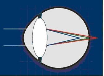 A diagram of a eyeball

Description automatically generated with medium confidence